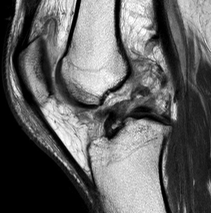 Knee Dislocation ACL PCL MCL MRI 2